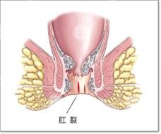 治疗肛裂多少钱